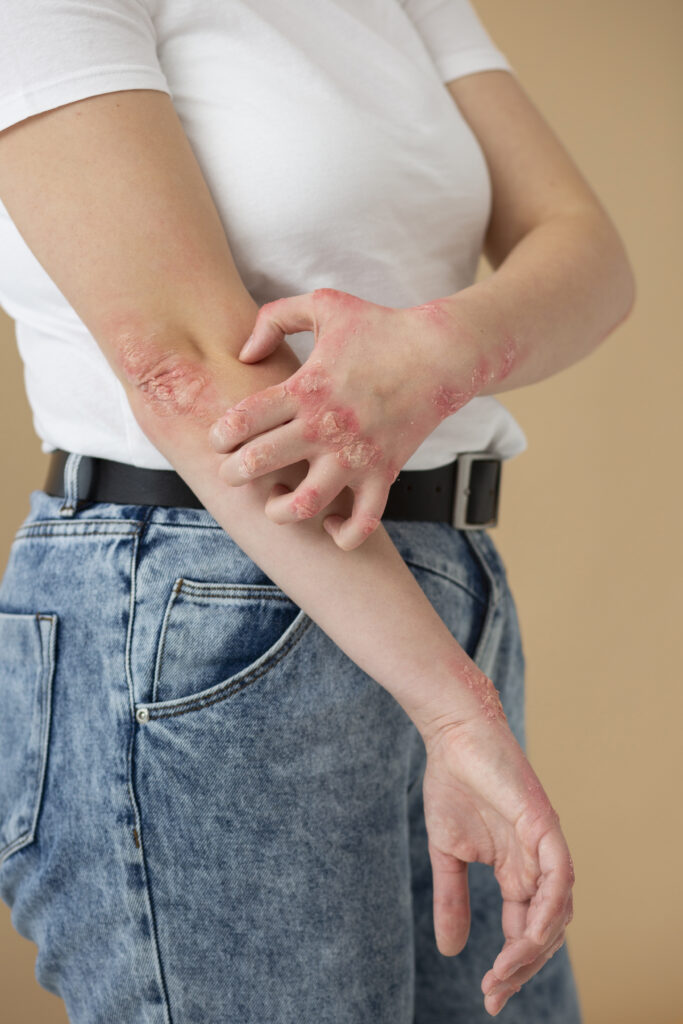 Image montrant des bras et des mains remplis de psoriasis