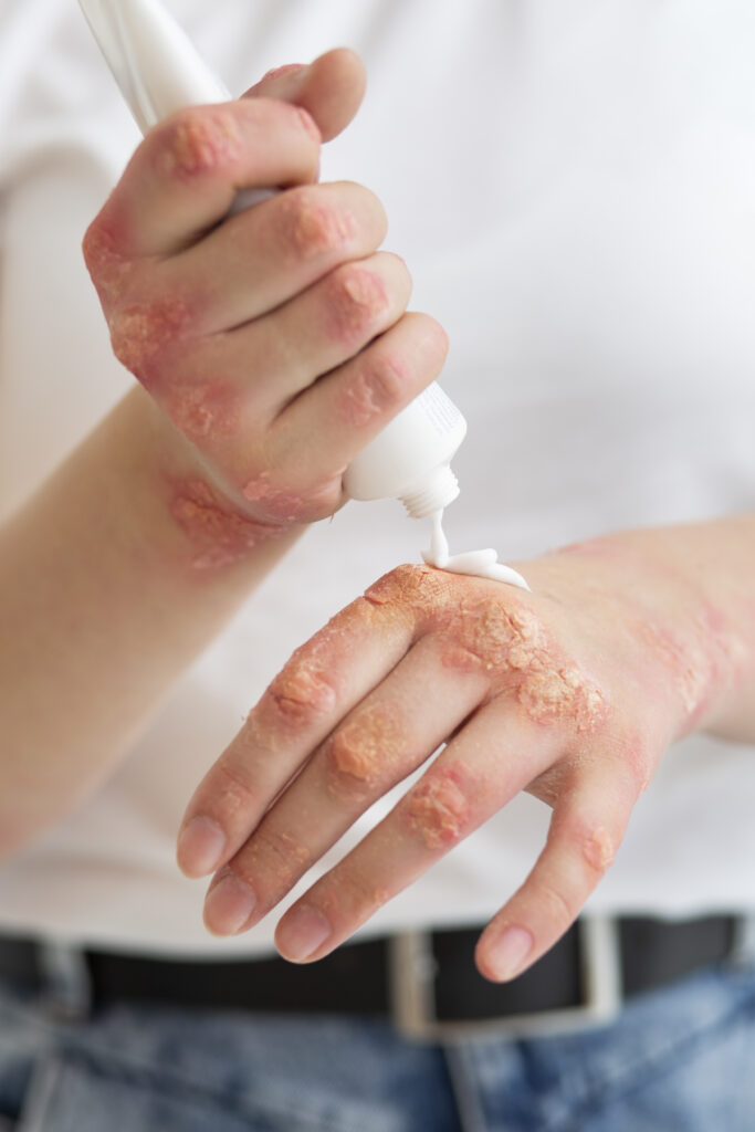 Image montrant quelqu'un mettre de la crème sur les plaque de psoriasis