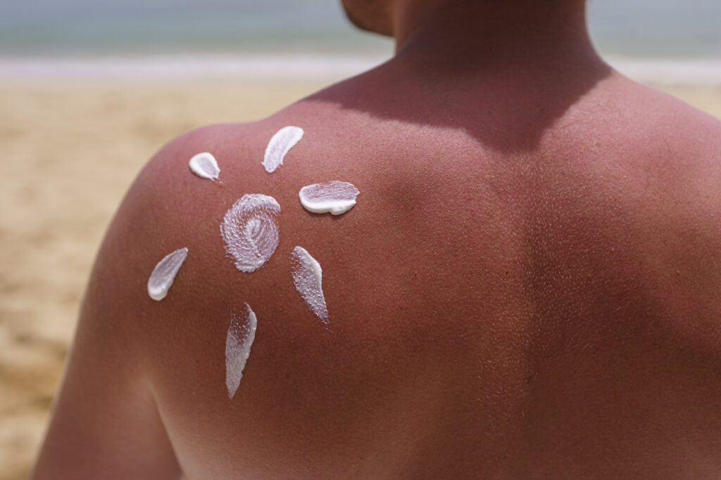 Photo d'une personne avec de la crème solaires sur le dos