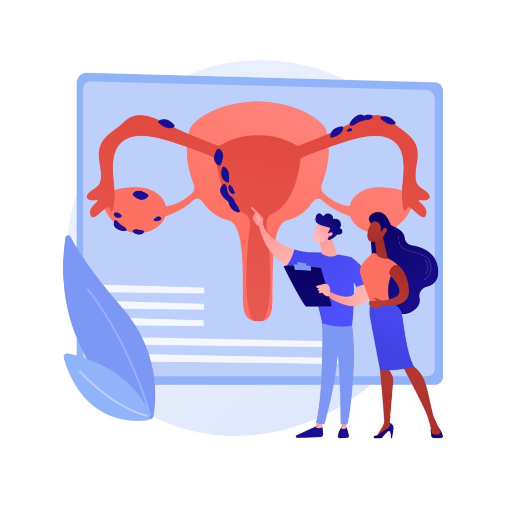Illustration de l'uterus ayant l'endometriose
